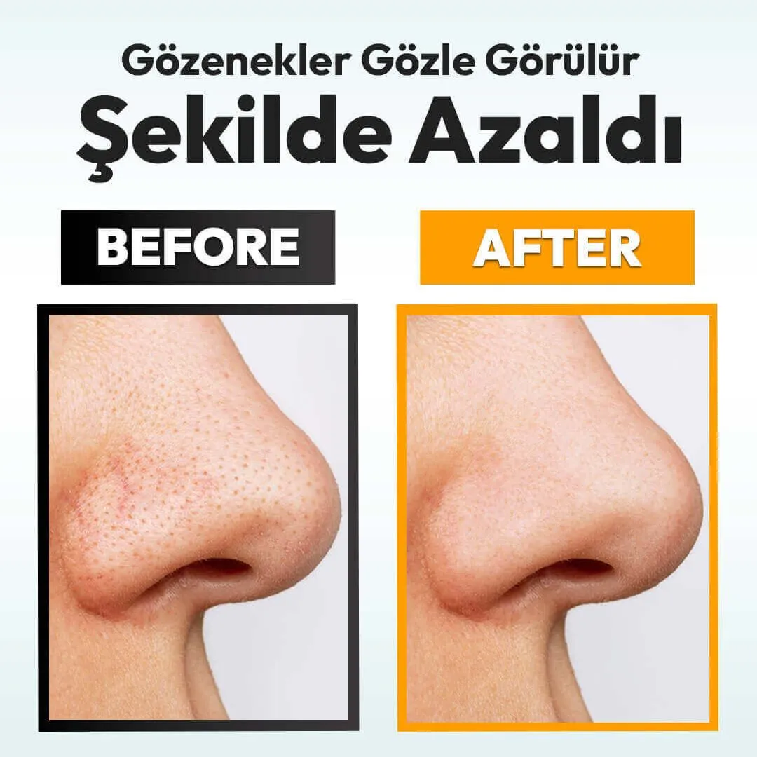 Öncesi sonrası gözenek karşılaştırması